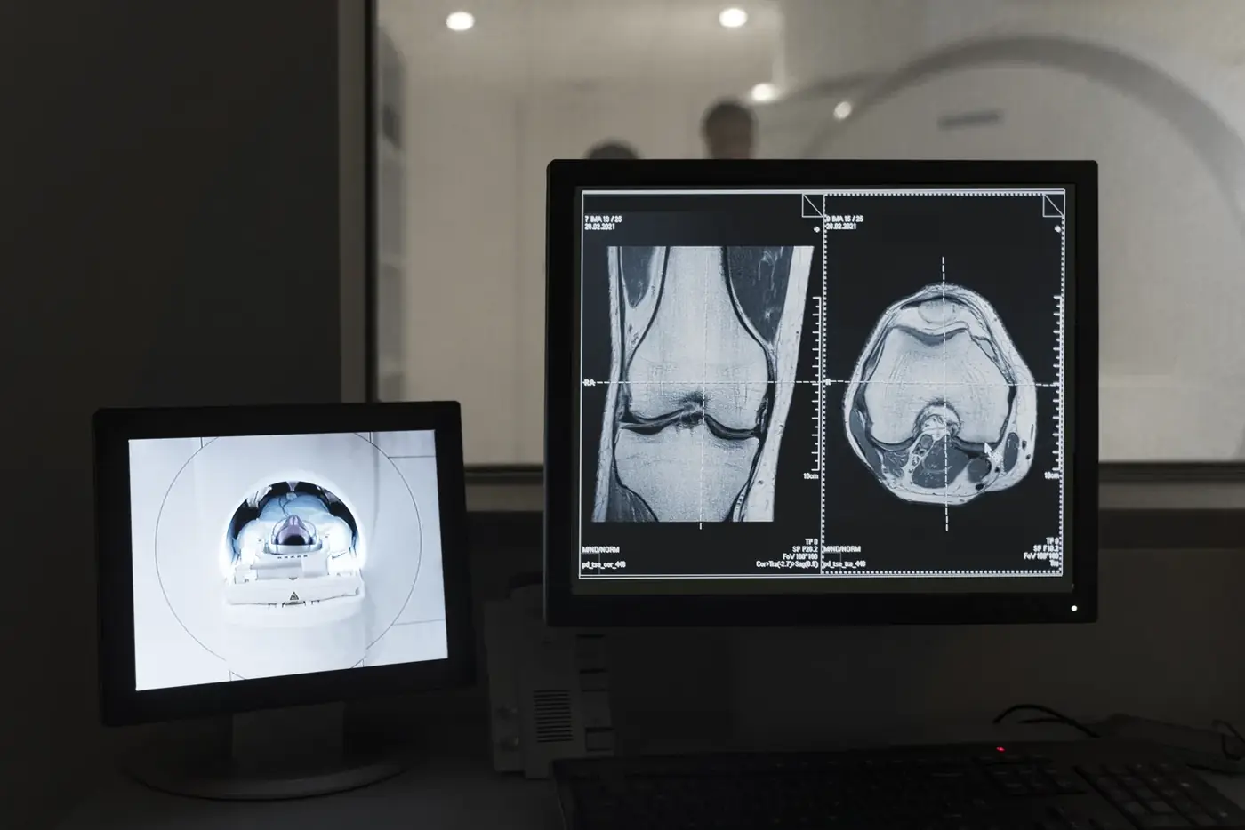 Immagini di risonanza magnetica del ginocchio sui monitor